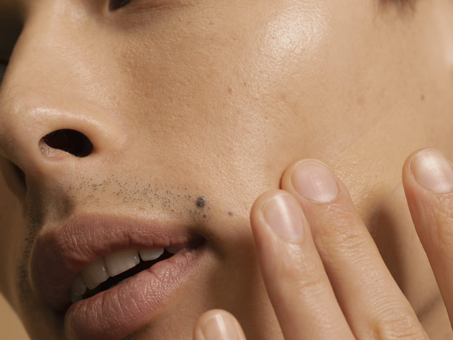 Can Biotin Cause Acne?